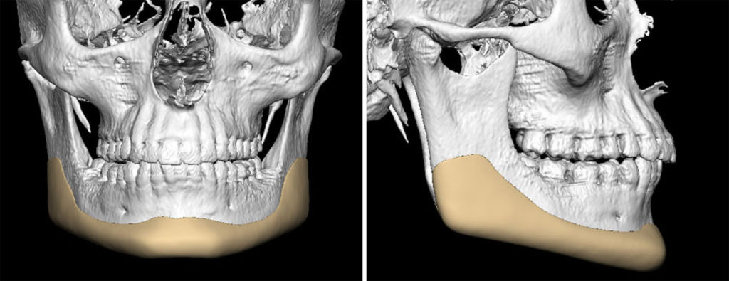 Plastic Surgery Case Study - Custom Jawline Defining Implant - Explore ...