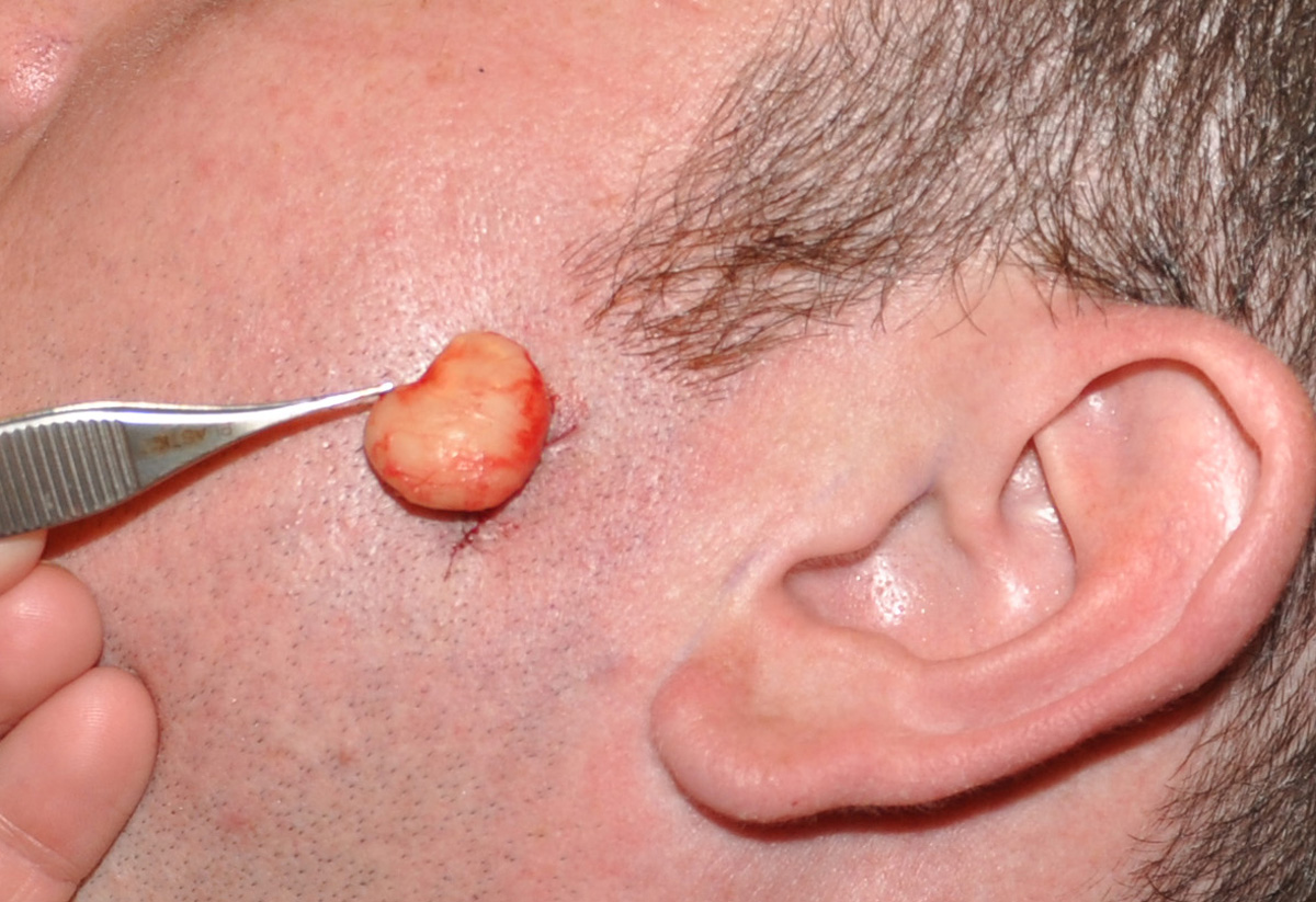 sebaceous cyst face removal