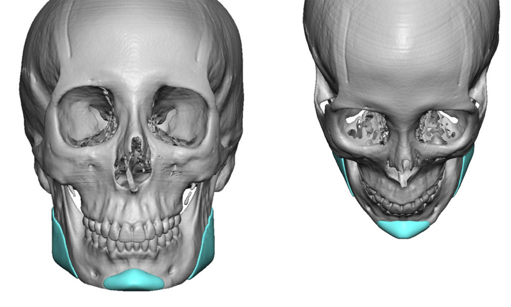 Plastic Surgery Case Study Female Custom VLine Jaw Implants
