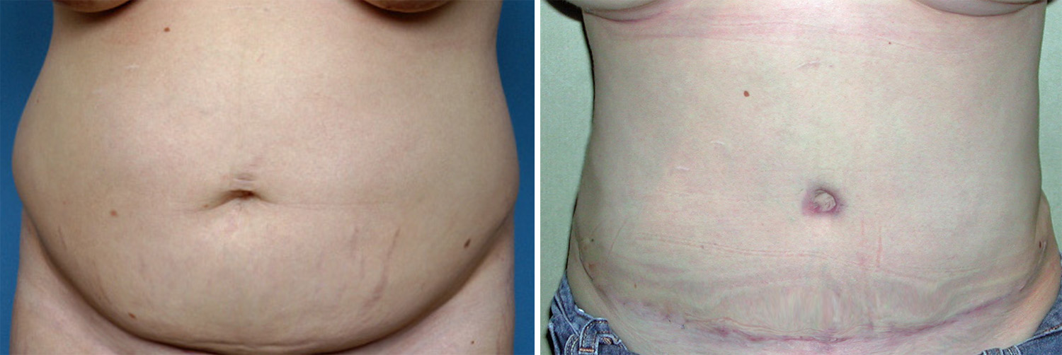 Plastic Surgery Case Study - Full Tummy Tuck and Flank Liposuction Before  Weight Loss - Explore Plastic Surgery