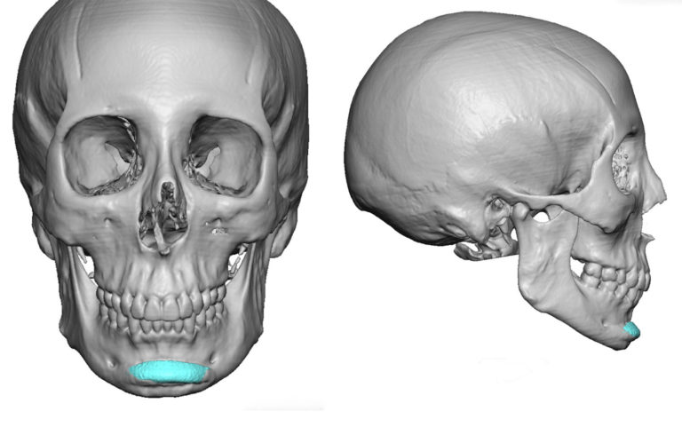 Plastic Surgery Case Study - Female Custom V-Line Jaw Implants ...