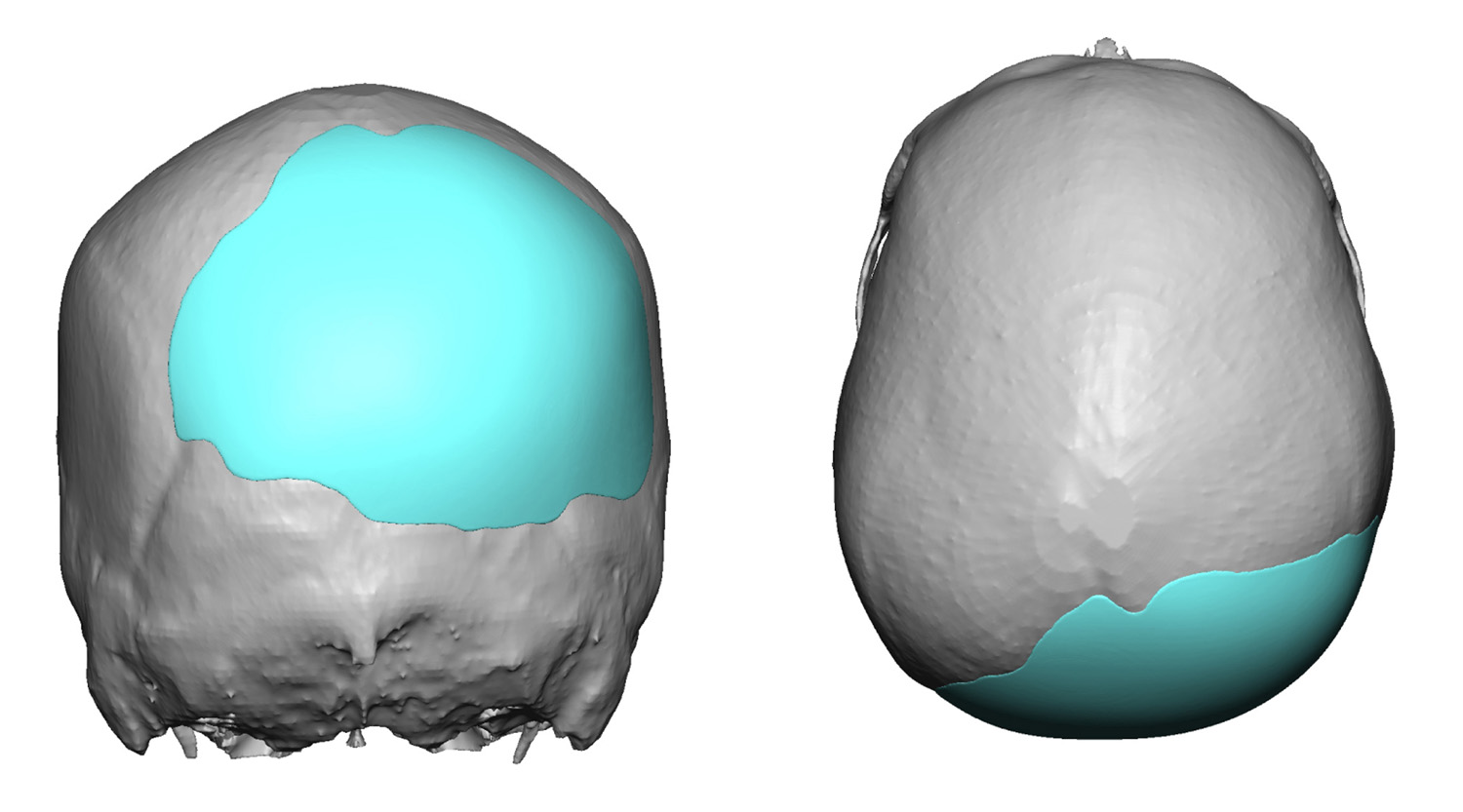 Custom Skull Implant Design For Occipital Plagiocephaly Correction