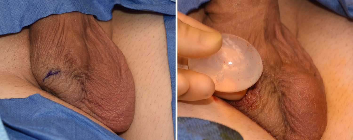 Under general anesthesia his existing mid-scrotal scar was used as access f...