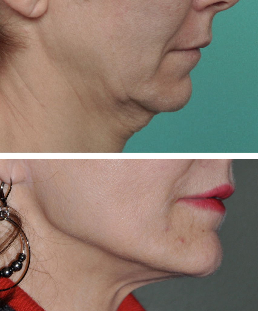 Female Jawline Augmentation in the Aging Face Explore Plastic Surgery