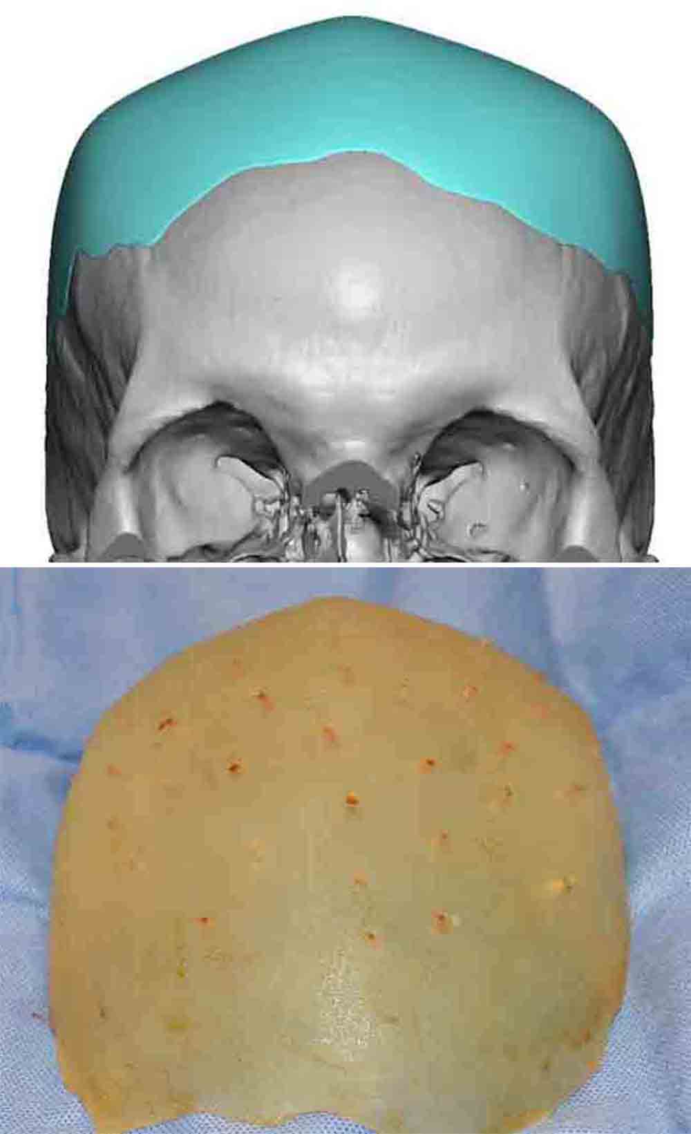 The Peaked Square Shaped Custom Skull Implant Design Explore Plastic