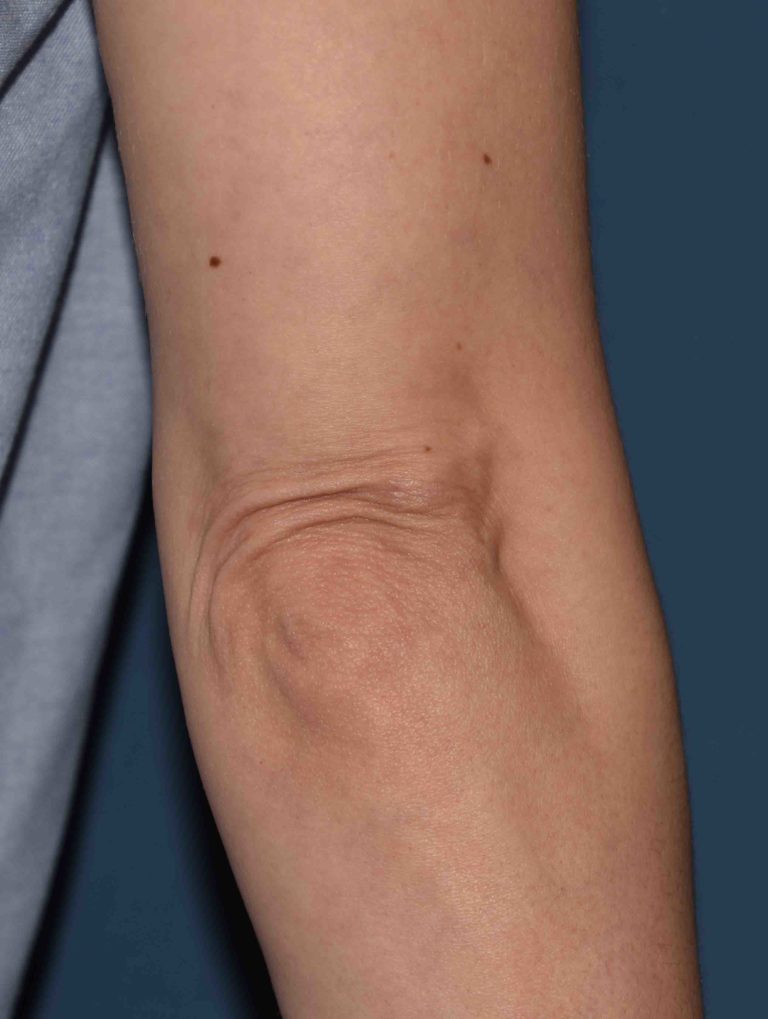 Elbow Skin Excess Explore Plastic Surgery elbow-skin-excess-explore-plastic-surgery