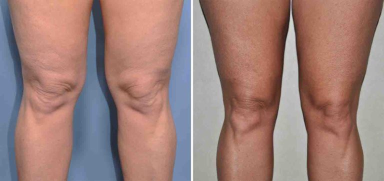 Bilateral Knee Liposuction Result Dr Barry Eppley Indianapolis Explore Plastic Surgery 