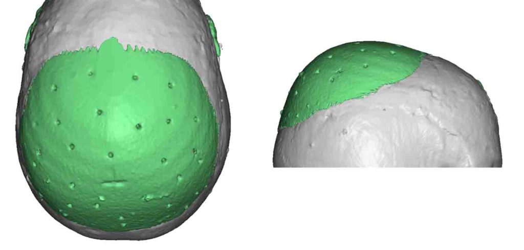 Technical Strategies - The Placement of Perfusion Holes in Custom Skull ...