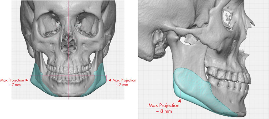 Plastic Surgery Case Study - Aesthetic Correction of the High Angle Jaw ...