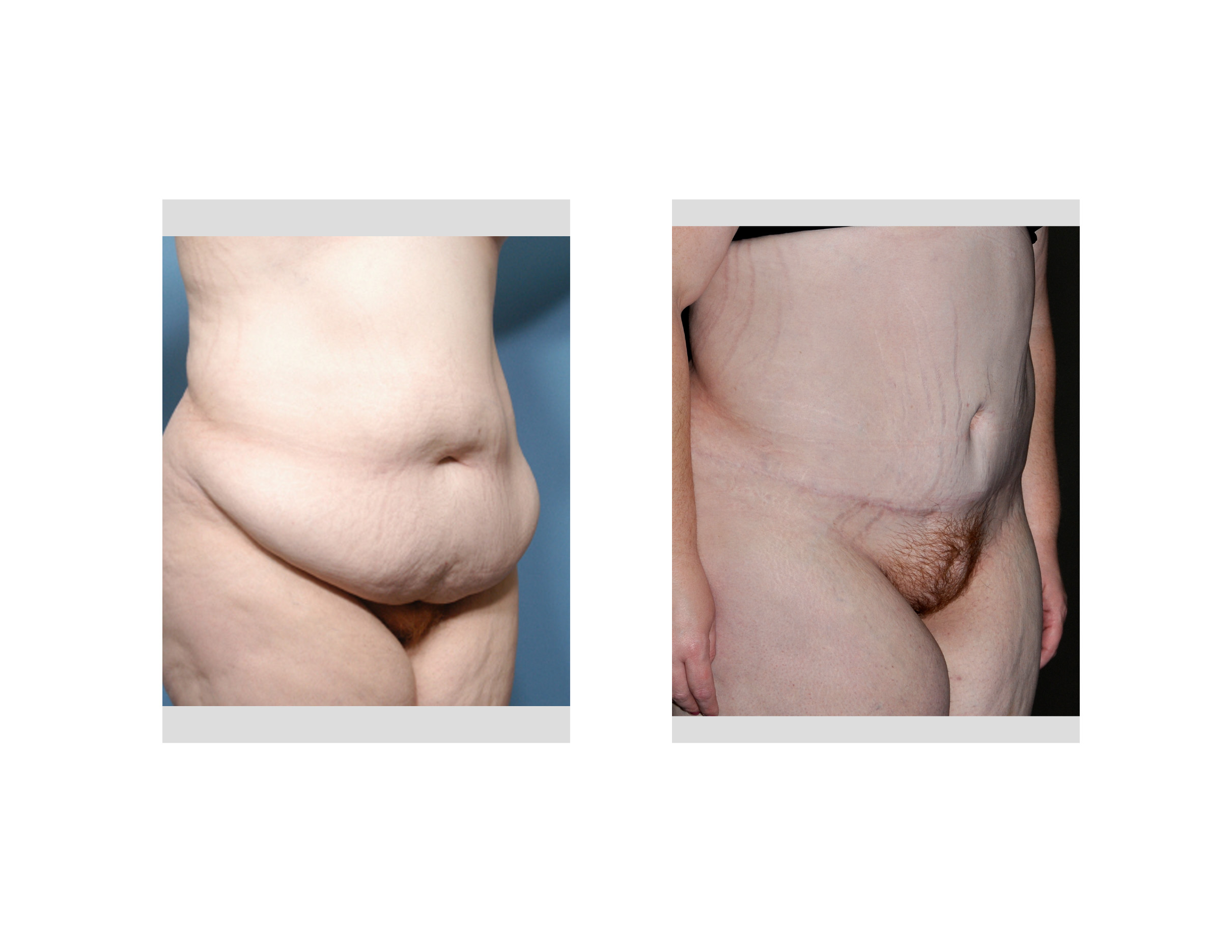 Enlarged & rounded mons pubis 2 years after tummy tuck? (Photo)