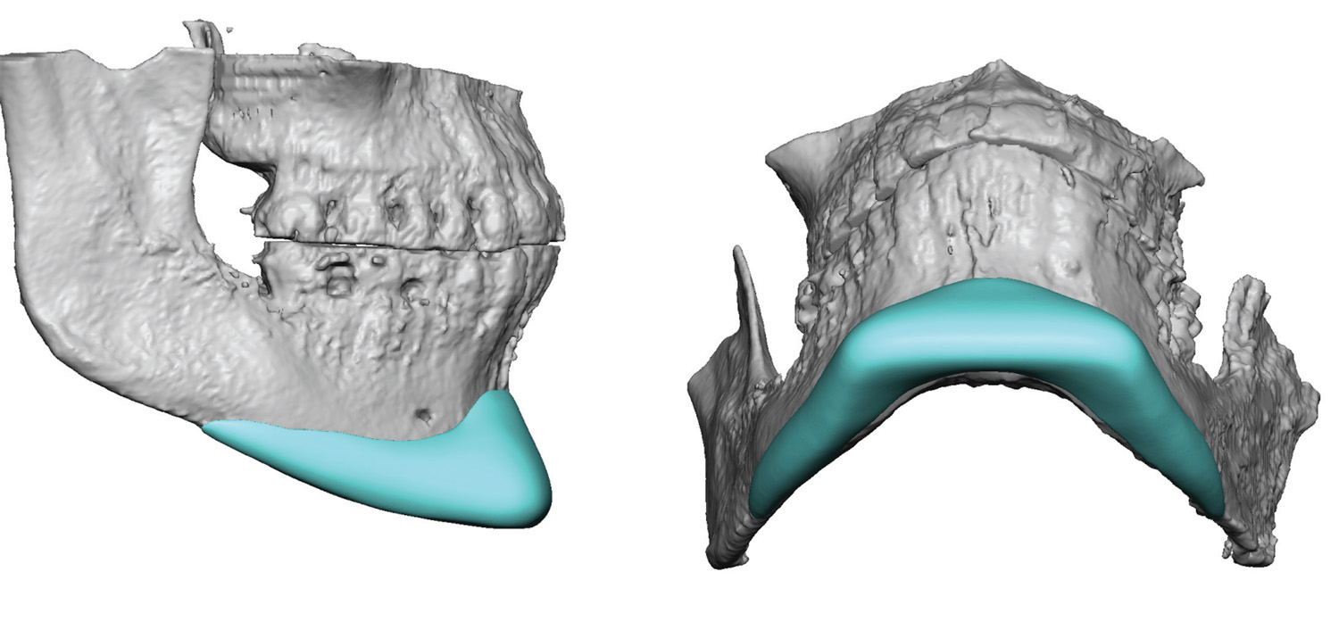 Plastic Surgery Case Study - Male Custom Square Chin Implant - Explore ...