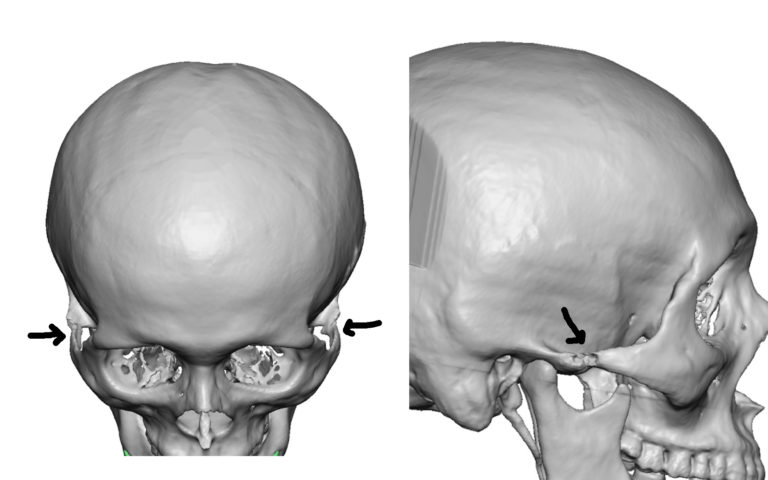 front of zygomatic arch