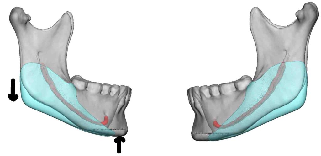 Vertical Lengthening Jaw Angle Impalnts In The High Mandibular Plane 