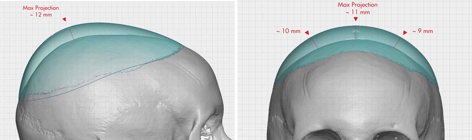Custom Crown Of Skull Implant Design Measurements Dr Barry Eppley