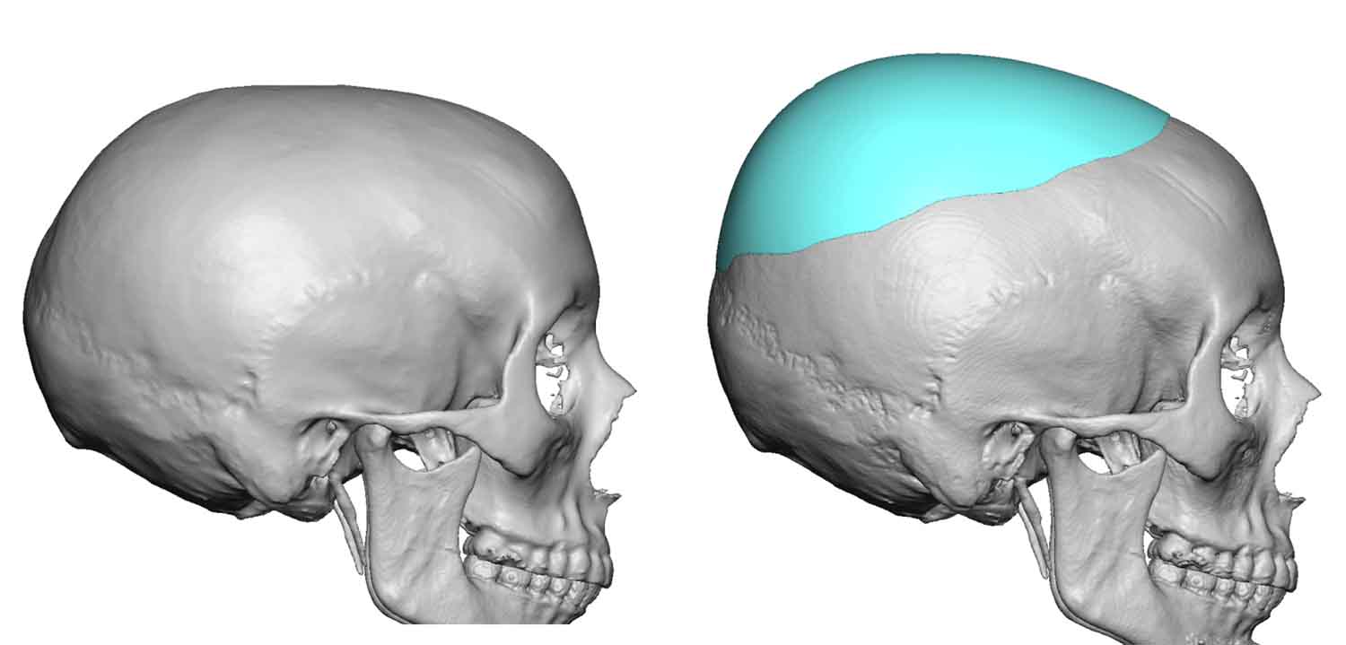 Custom Crown Of Skull Implant Design Side View Dr Barry Eppley Indianapolis Explore Plastic Surgery