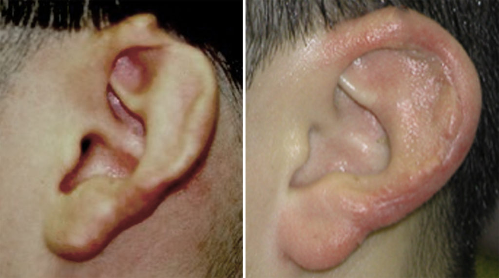 Plastic Surgery Case Study Ear Reconstruction with Skin Flap and