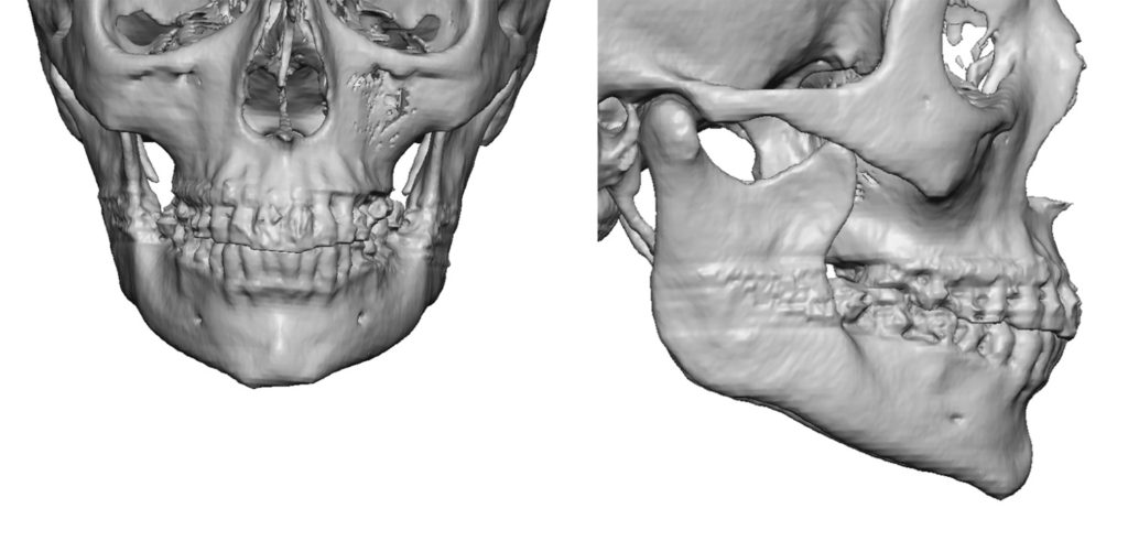 Plastic Surgery Case Study - Female Custom Chin Implant - Explore ...