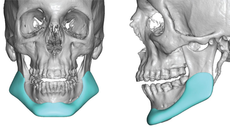 Plastic Surgery Case Study - Custom Jawline Implant Replacement for ...