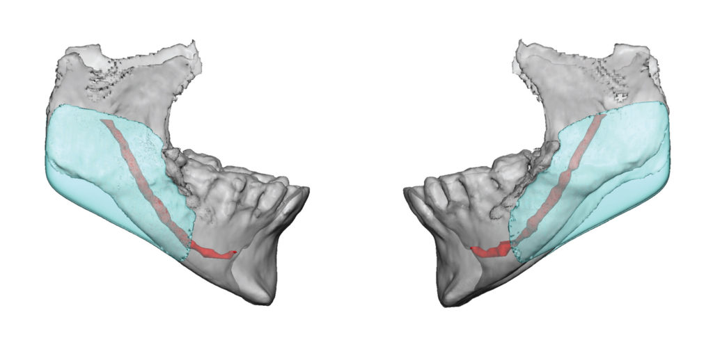 Custom Jaw Angle Implants for Bony Reconstruction after Sagittal Split ...