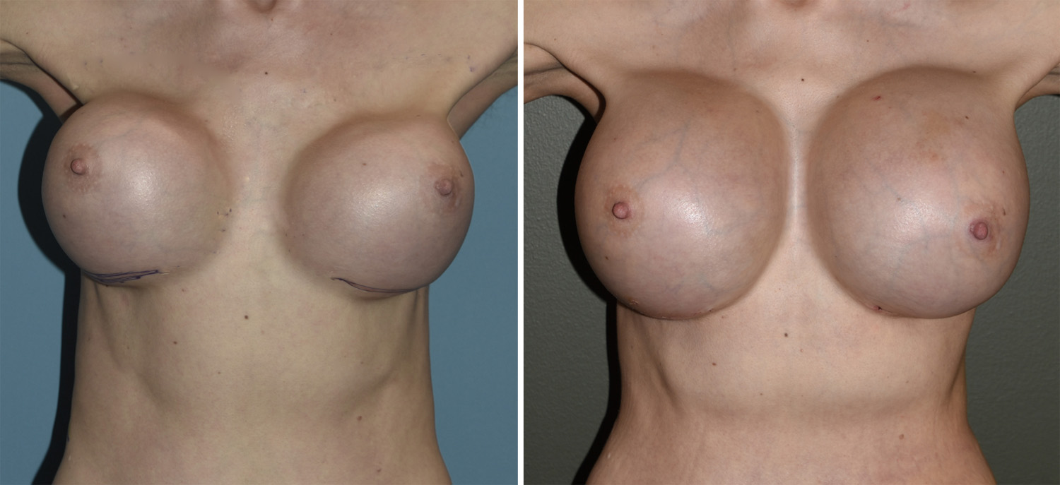 Extreme breast implants.