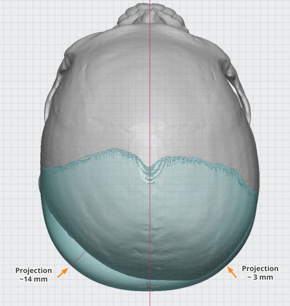 Custom Occipital Skull Implant For Asymmetry Design Dr Barry Eppley