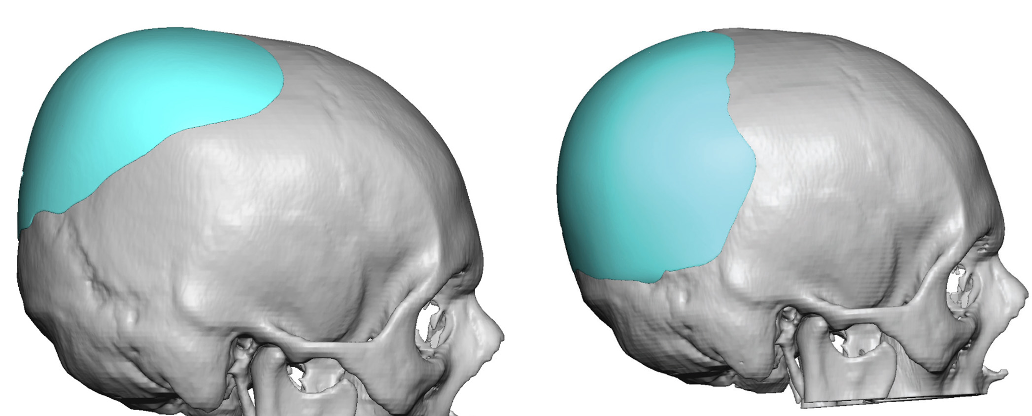 Plastic Surgery Case Study Custom Skull Implant Replacement For