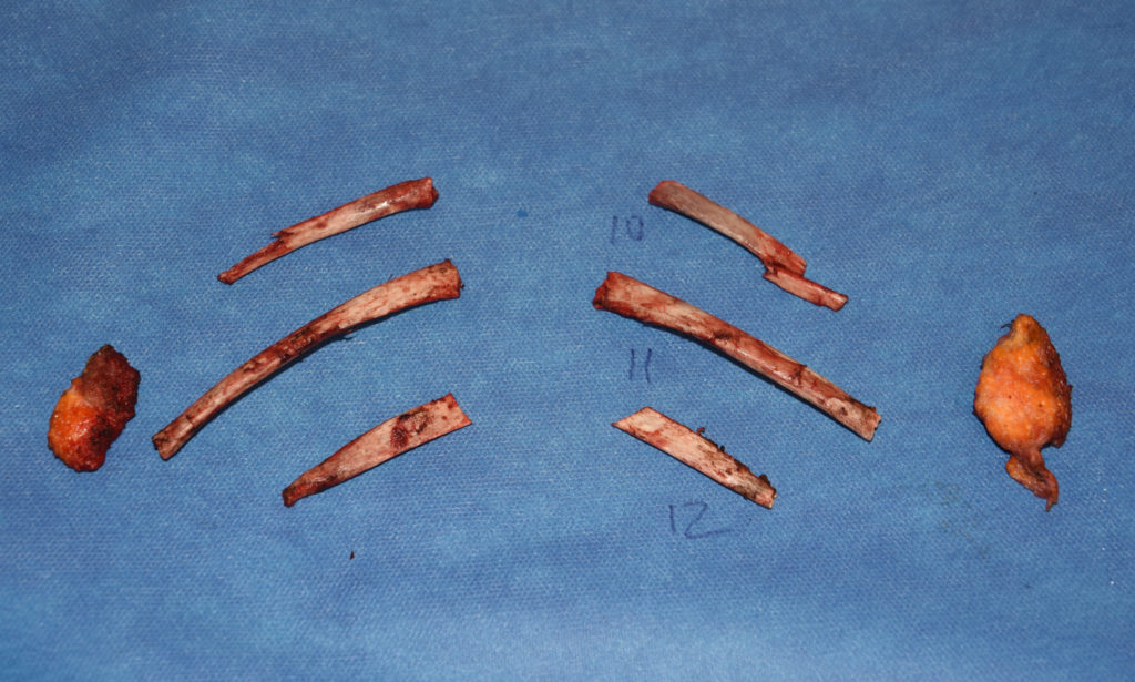 Rib Removcal with Myectomy Waistlien Reduction Dr Barry Eppley ...