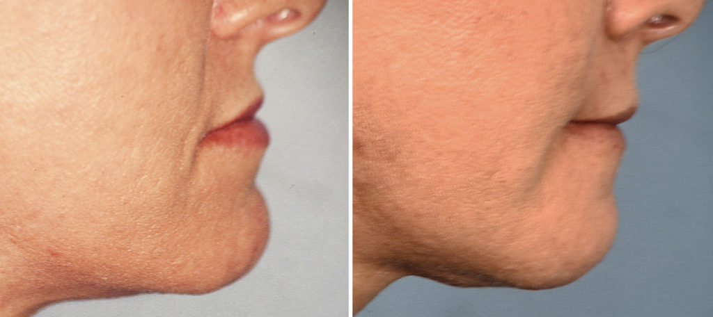 Plastic Surgery Case Study - Reverse Sliding Geniplasty for Chin ...