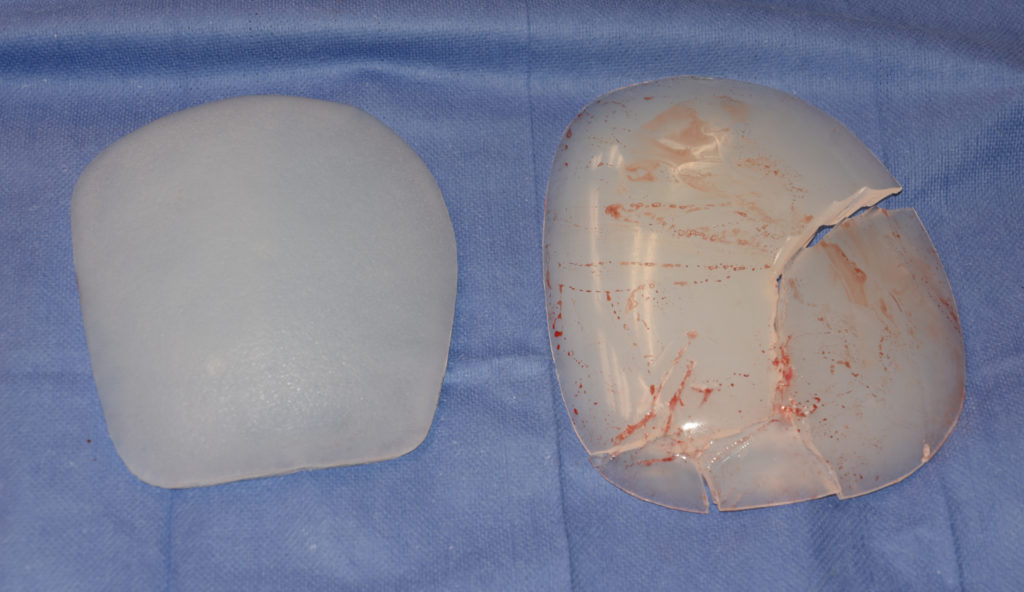 OR Snapshots Pectoral Implant Replacements Explore Plastic Surgery