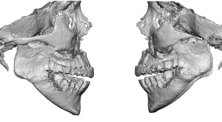 Jaw Angle Deformity after Sagittal Split Mandibular osteotomies 3D side ...