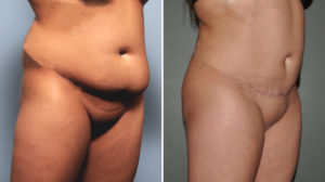 The Impact of Pregnancy On A Tummy Tuck - Explore Plastic Surgery