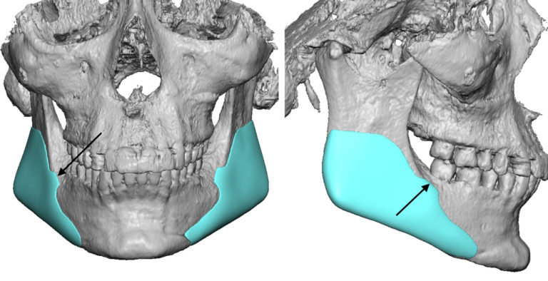 Plastic Surgery Case Study - Custom Jaw Angle Implants after Sagittal ...