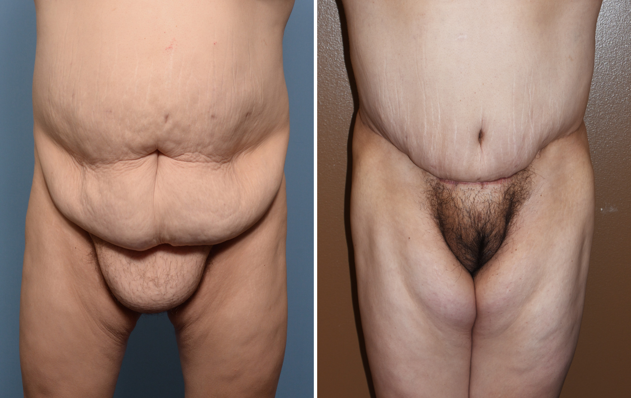 Plastic Surgery Case Study - Combined Abdominal Panniculectomy and Pubic  Lift for Treatment of the Triple Roll Abdominal Deformity - Explore Plastic  Surgery