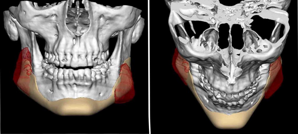 jawline jaw implant eppley asymmetry exploreplasticsurgery
