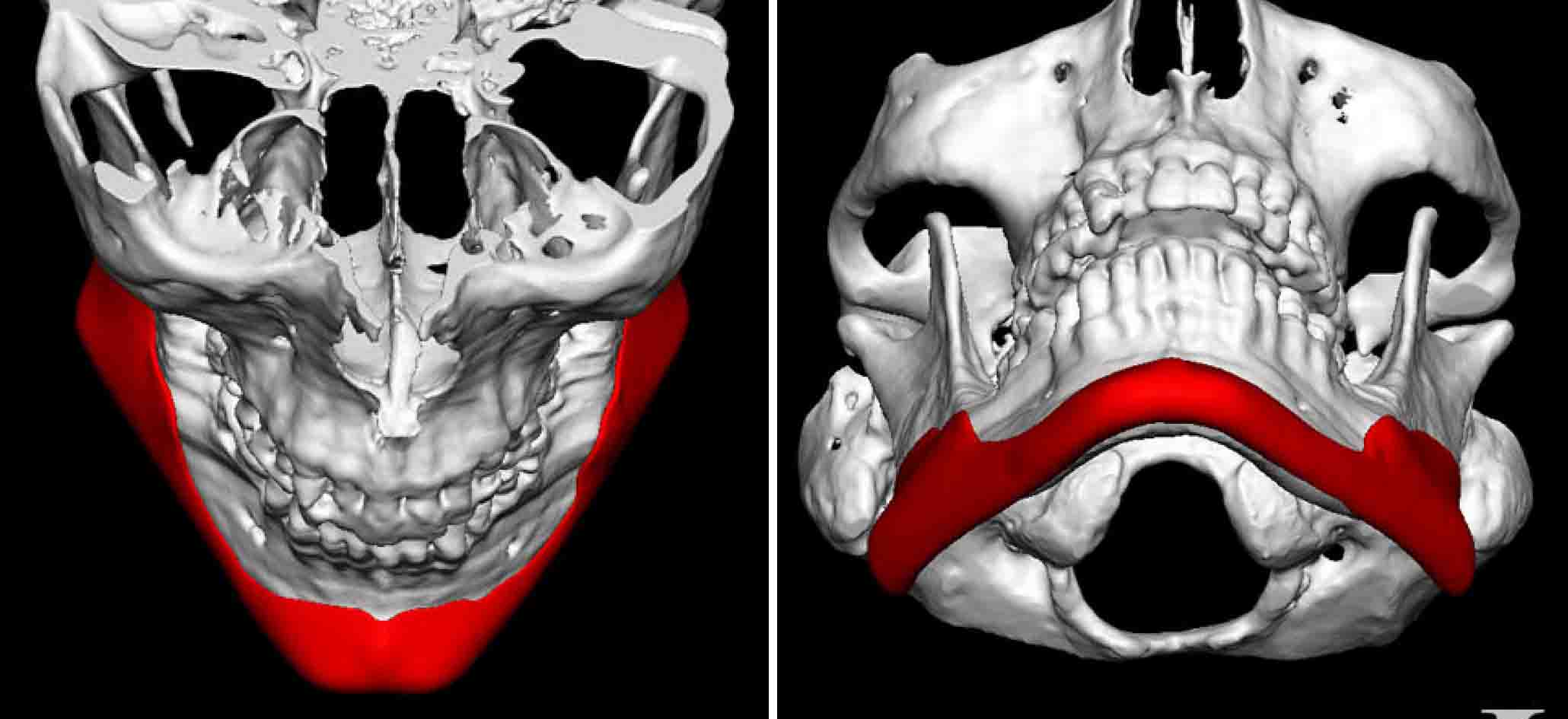 custom-jaw-angle-implant-design-dr-barry-eppley-indianapolis - Explore  Plastic Surgery