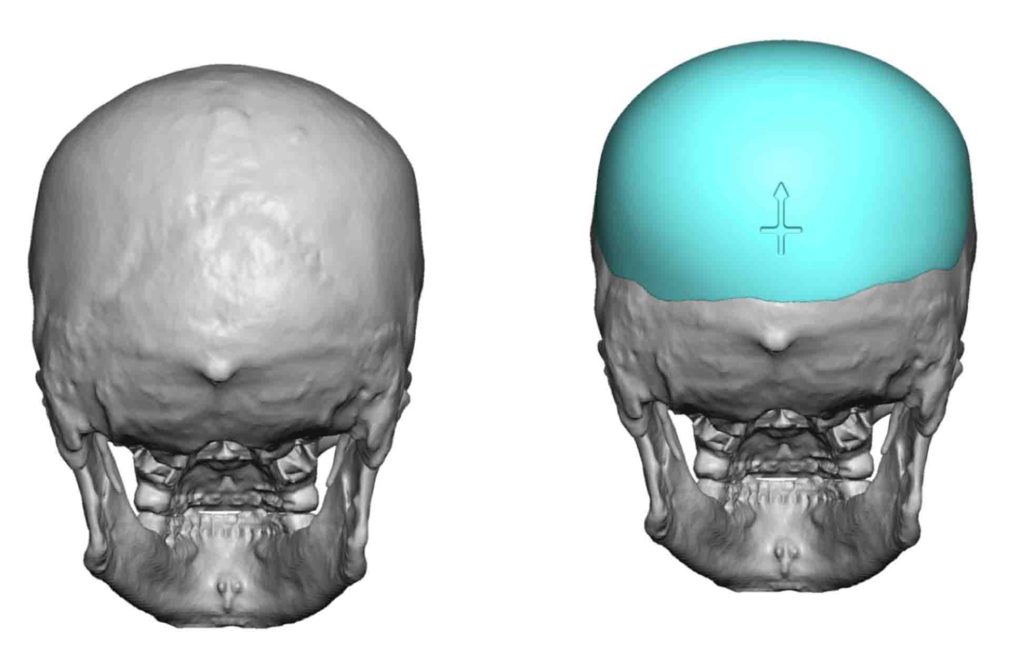 Plastic Surgery Case Study Custom Skull Implant For Occipital Skull