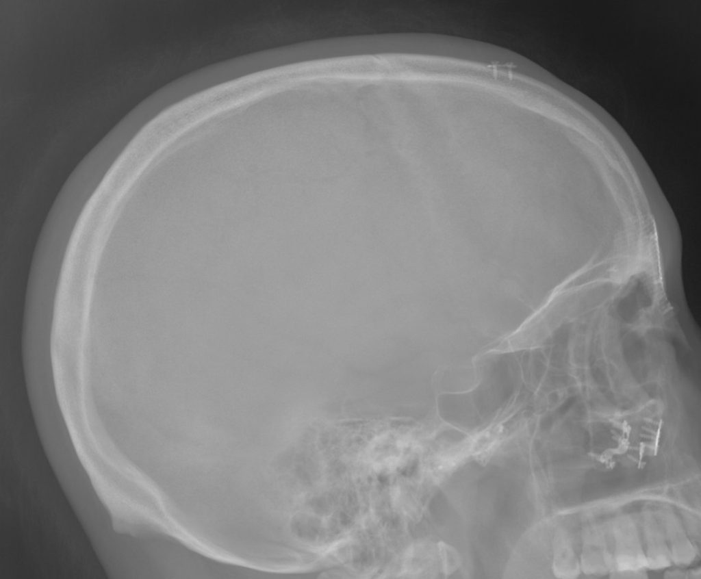 Skull Bone Loss With Aging Explore Plastic Surgery