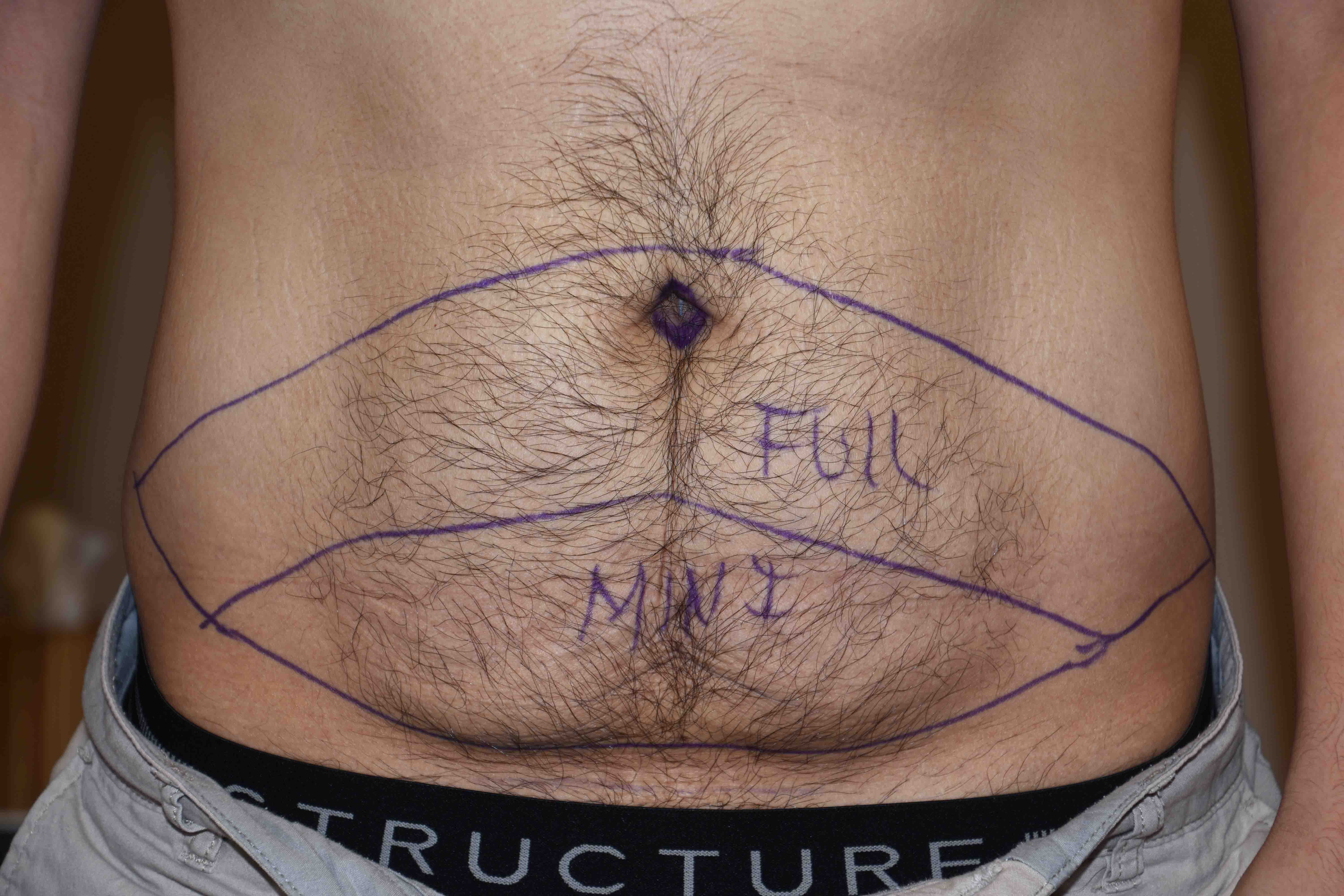 Clinic Snapshots - Male Tummy Tuck Options - Explore Plastic Surgery