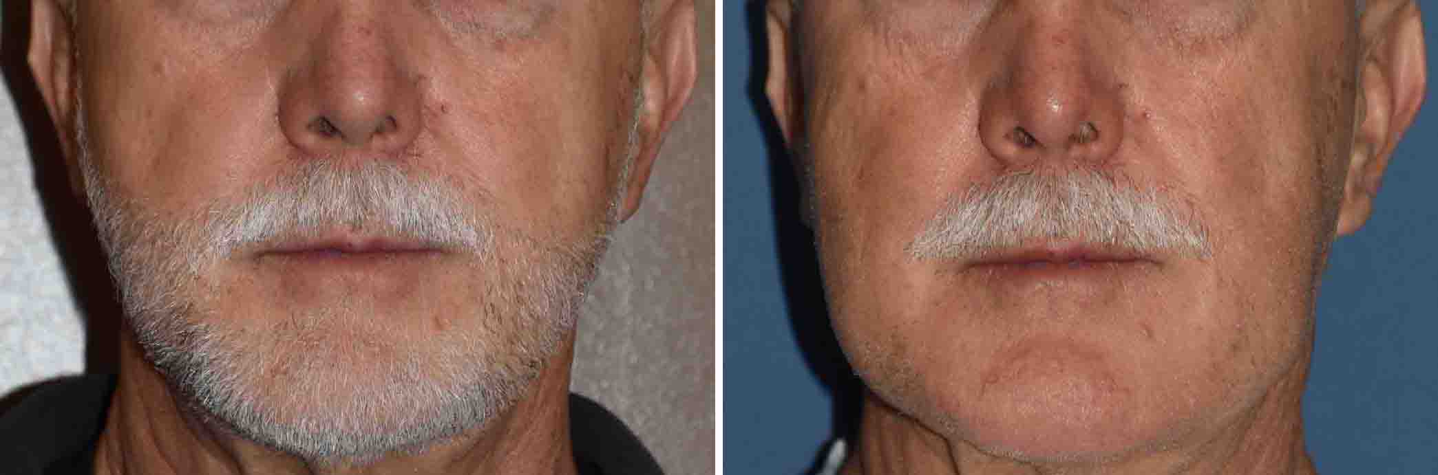 Plastic Surgery Case Study Custom Jawline Implant for