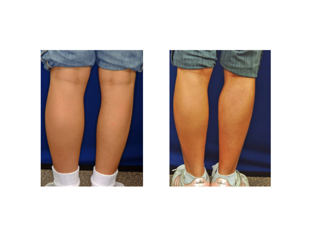 Calf Implants and Fat Grafting in Congenital Club Foot Deformity