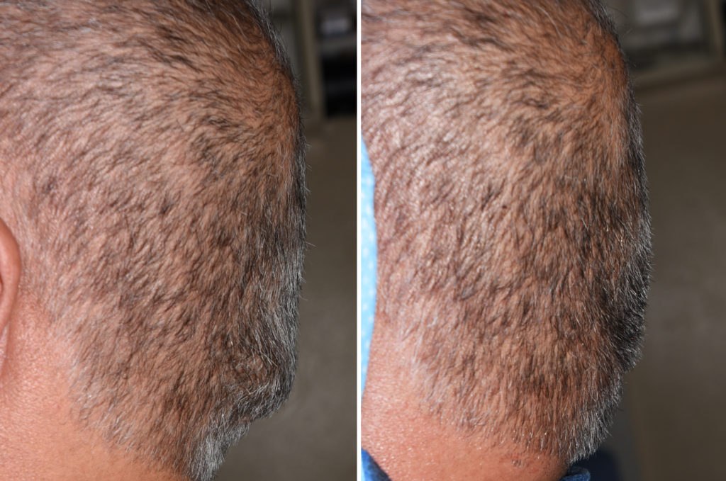 Plastic Surgery Case Study The Occipital Knob Skull Reduction