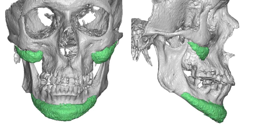 Plastic Surgery Case Study - Custom Jawline Implant Replacement of an ...