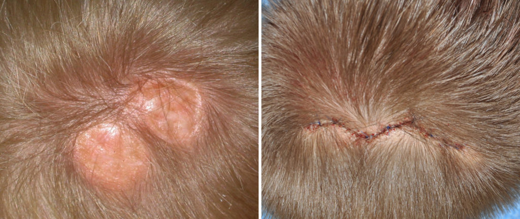 Plastic Surgery Case Study - Pediatric Scalp Reconstruction of Cutis ...