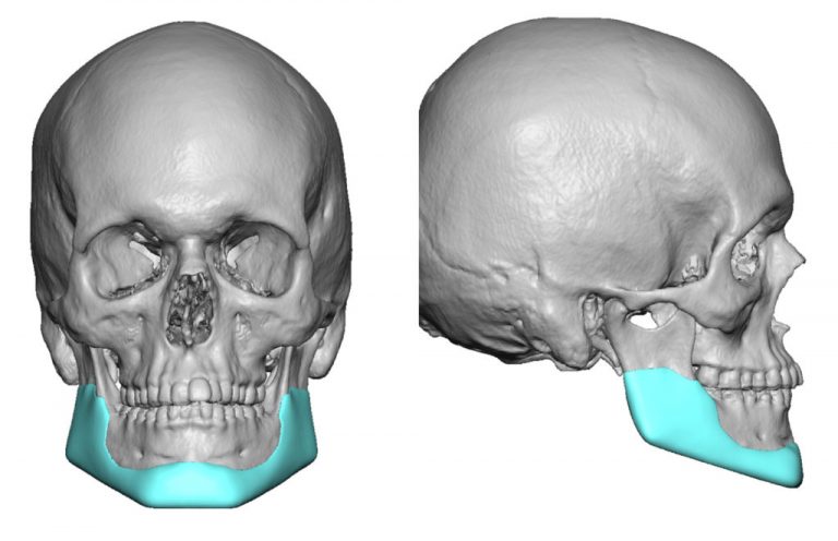 Plastic Surgery Case Study - Anterior Vertically Lengthening Custom ...