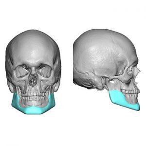 Plastic Surgery Case Study - Anterior Vertically Lengthening Custom ...