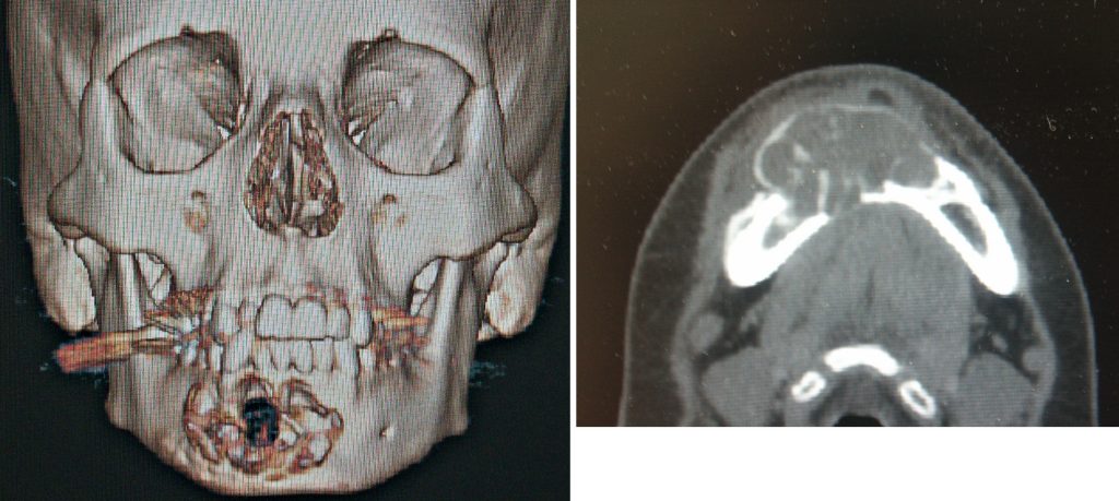 Technical Strategies 3d Modeling In Jaw Cyst Reconstruction Explore Plastic Surgery 5327