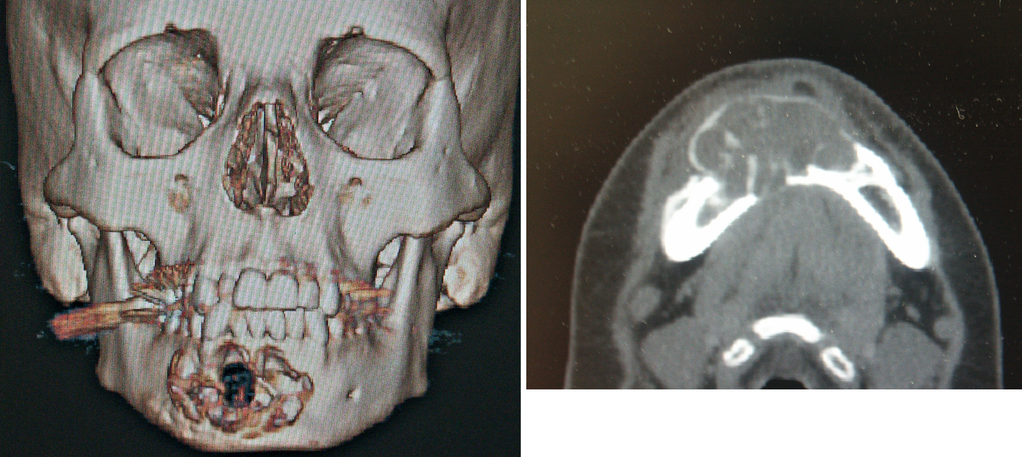 Technical Strategies 3D Modeling in Jaw Cyst Reconstruction Explore