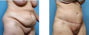 Case Study: Tummy Tuck for the Clefted Abdominal Pannus in a Hispanic  Female - Explore Plastic Surgery