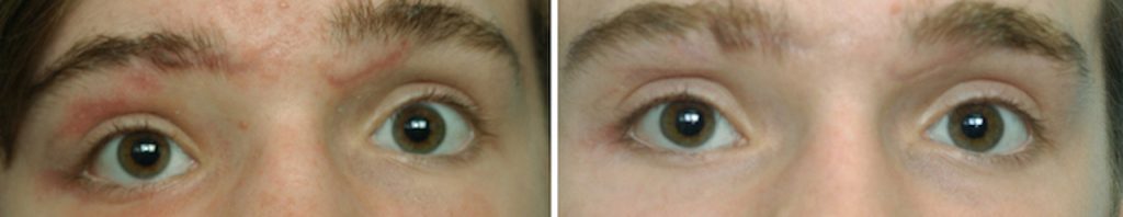 Plastic Surgery Case Study - Post Traumatic Vertical Orbital Dystopia ...