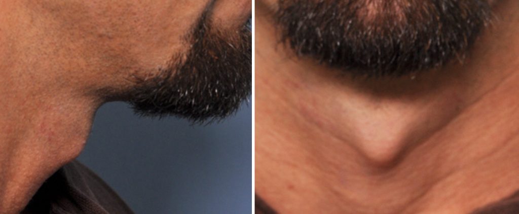 Plastic Surgery Case Study - The Male Tracheal Shave - Explore Plastic ...